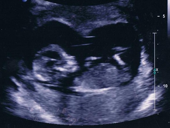 18 Weeks Pregnant